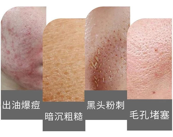 如何預(yù)防毛孔堵塞？預(yù)防毛孔堵塞的方法