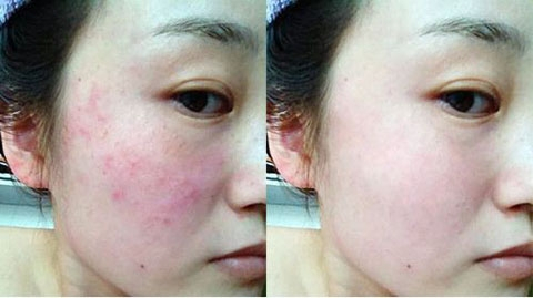 過敏肌膚怎么修復(fù)最快？