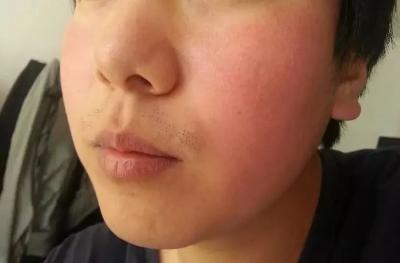 紅血絲的種類有哪些？