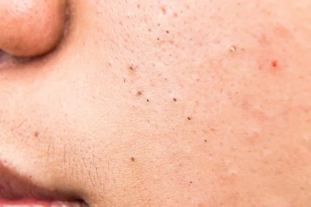 黑頭是怎么形成的？如何預防黑頭的產(chǎn)生？