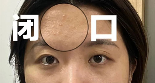 閉口粉刺形成的原因有哪些？