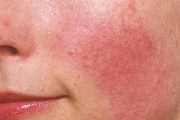 換季皮膚過敏怎么辦？換季皮膚過敏的解決辦法！